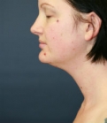 Feel Beautiful - Neck Liposuction San Diego Case 17 - Before Photo